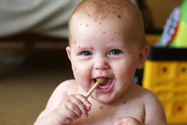¿Cuáles son los primeros síntomas de la varicela? 