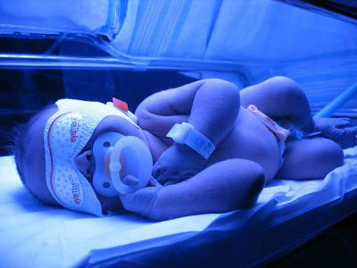 Fototerapia en recién nacidos con ictericia