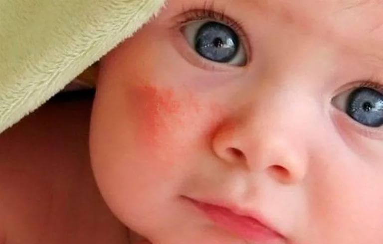 ¿En que consiste la dermatitis infantil?