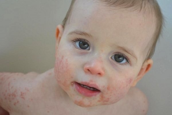 Ungüentos para niños con dermatitis atópica