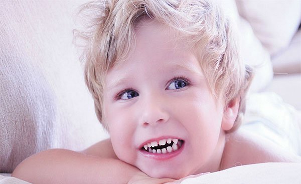 Bruxismo: Cuando el niño rechina los dientes